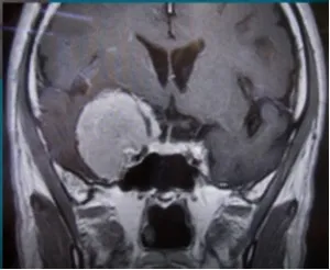 脑膜瘤4cm严重吗？当巨大脑瘤“静悄悄”地长进海绵窦，必须手术？