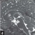 囊肿被完全切除