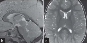 头痛呕吐1年多却查不出病因，这个松果体囊肿为何像“隐身”了？