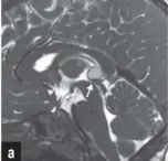 由于此前检查发现侧脑室无扩张，因此在当时被忽视了的松果体囊肿