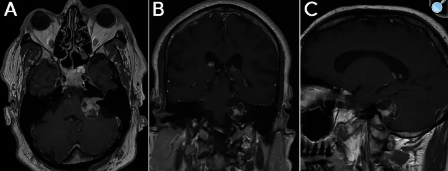 图1.术前轴位、冠状位及矢状位MRI，显示一大小约3厘米、部分囊性、呈对比强化的病变，扩大内听道并充满桥小脑角，符合Koos 4级听神经瘤。