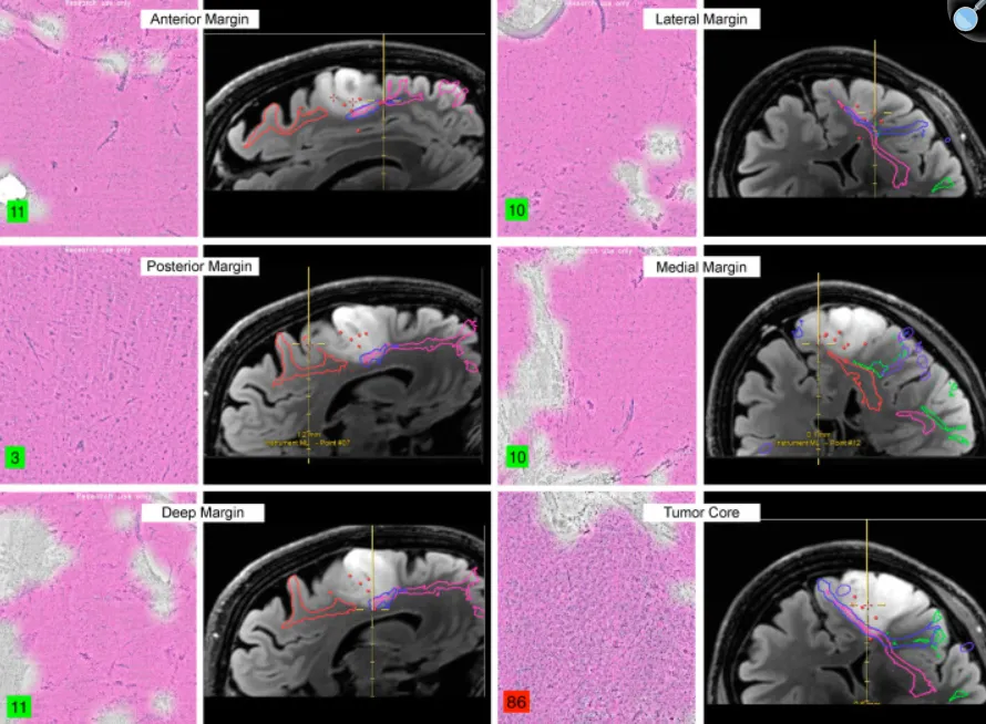 胶质瘤边界模糊不清？当外科医生手握这些“神器”，手术切除可以多精准？
