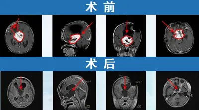 随访时，肿瘤并未复发，孩子的视力也在一步步恢复，已经可以准确抓取物品了，这意味着手术保住了孩子的视力。