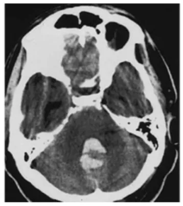 CT显示第四脑室出血