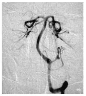 脑血管造影显示动脉瘤位于左侧小脑后下动脉扁桃体延髓段