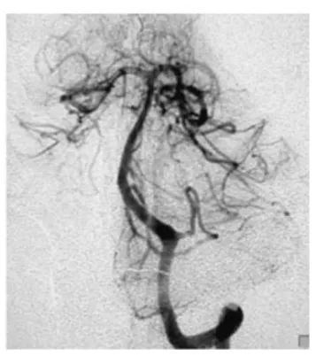 术后血管造影证实动脉瘤完全闭塞