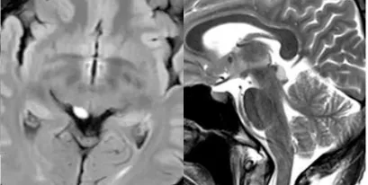 1厘米的脑干结节，做了PET-MR和活检仍难断善恶？最终诊断，谁说了算？