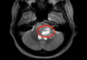 最初进行穿刺活检，显示弥漫性中线胶质瘤（WHO IV级），恶性程度高，预后极差。