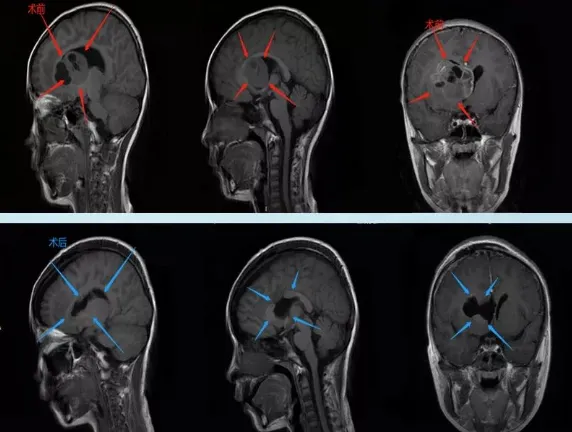 5cm巨大基底节区肿瘤安全切除