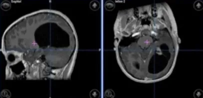 毛细胞性星形细胞瘤