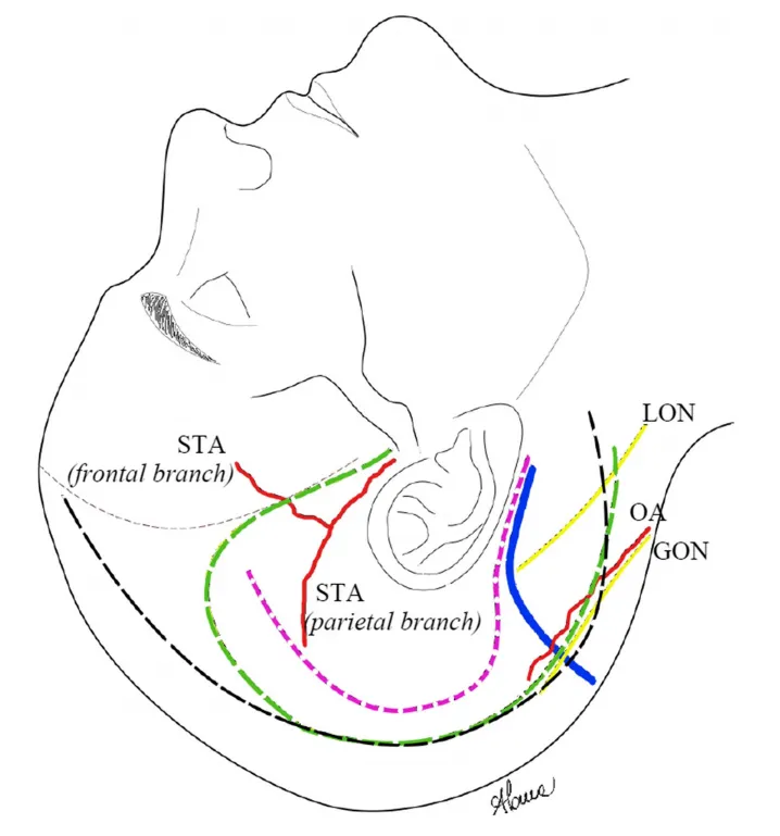改良皮肤切口（粉色线）与标准切口（绿色和黑色线）示意图，并标出了会遇到的主要皮下神经血管结构。 STA， 颞浅动脉； LON， 枕小神经； GON， 枕大神经； OA， 枕动脉。