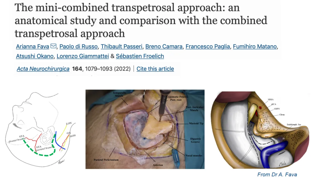 mini-combined transpetrosal approach（Mini-CTPA）