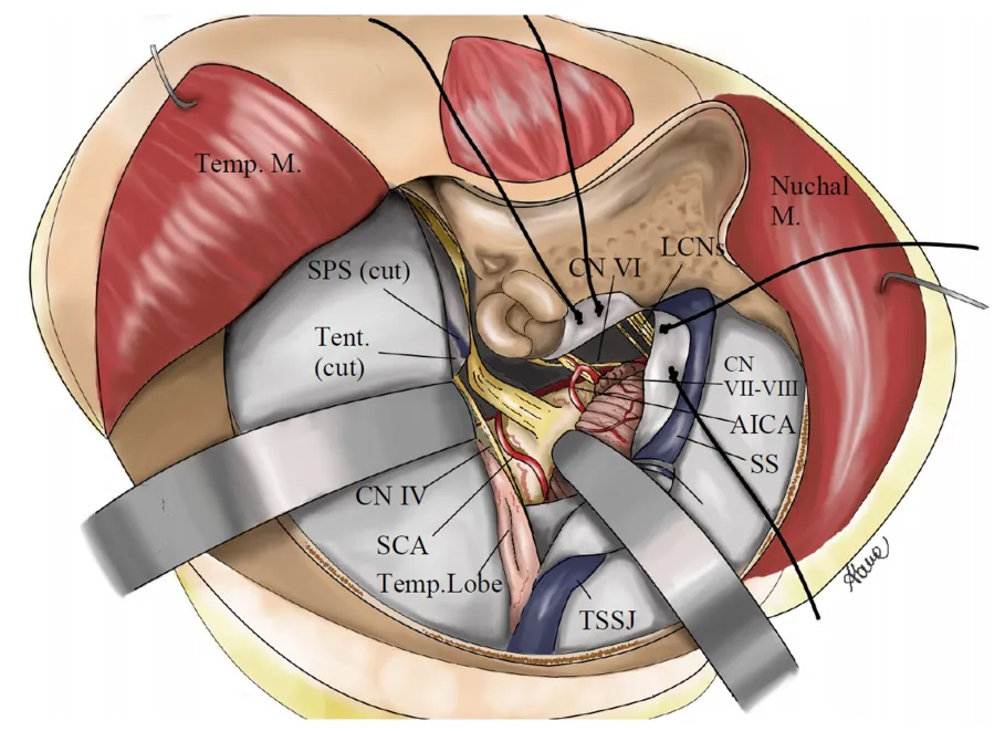 手术通道示意图：右侧mini联合经岩骨入路