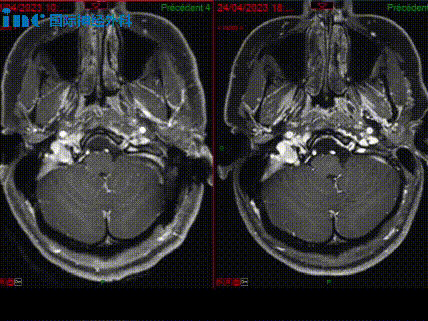 术后（左侧）与术前（右侧）影像对比
