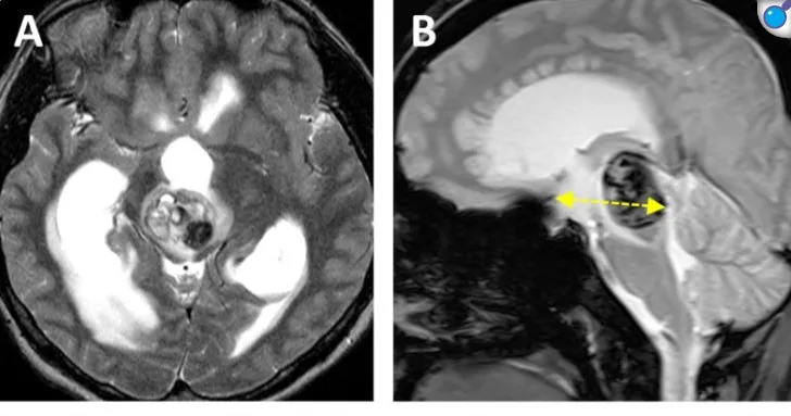 图 a, b 术前MRI显示被归类为"中央区病变"的中脑海绵状血管瘤出血。黄色虚线标示肿瘤深度（42.5 mm）。