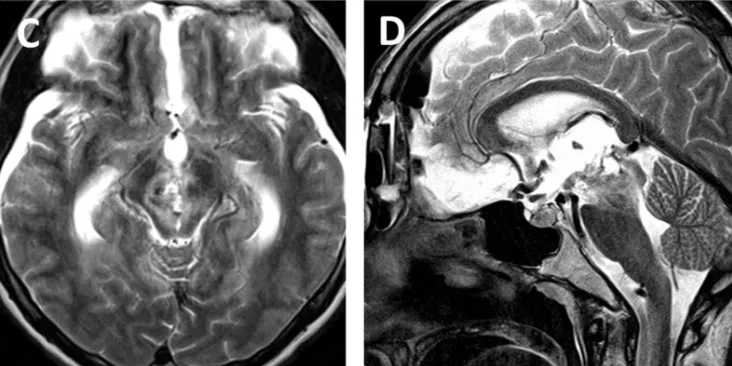 术后MRI显示轴内血肿及血管病变已完全切除（图c, d）。