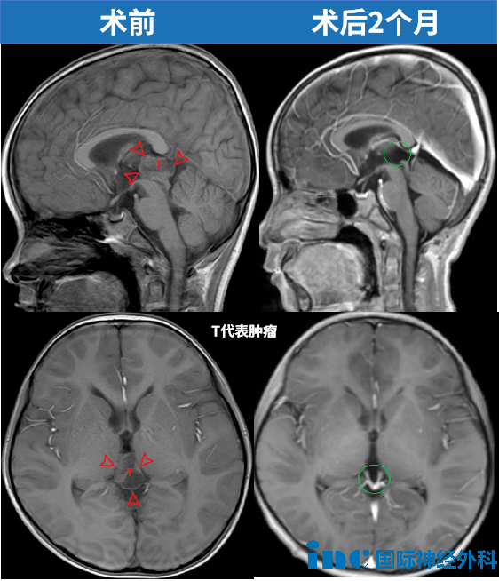 术前术后MRI对比