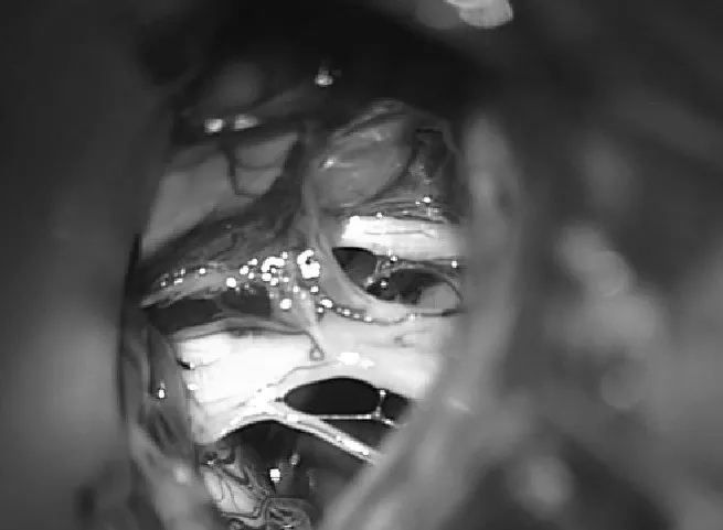 抽吸脑脊液后，仔细地从周围血管和神经结构上解剖囊肿壁，以获得全切（图2）。