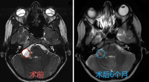 长在大脑“隐秘的角落”，这个良性病变差点让孩子失去听力