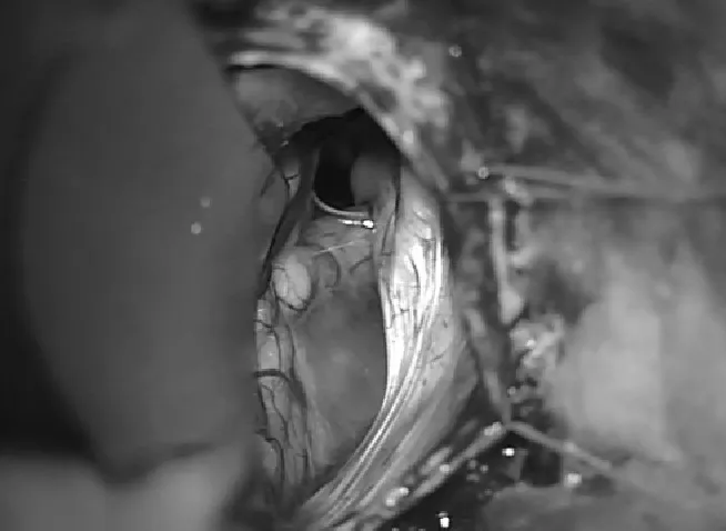 在温和的回缩后，蛛网膜囊肿的后壁可见（图1）并被打开。