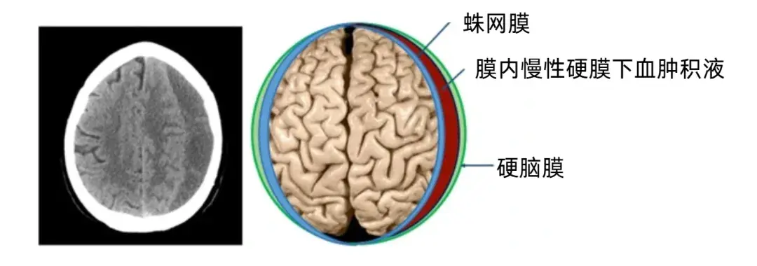 蛛网膜  膜内慢性硬膜下血肿积液  硬脑膜