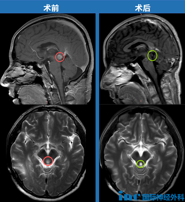 术前术后MRI对比