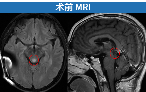 术前MRI