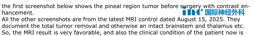 第一张截图显示的是手术前松果体区肿瘤的增强影像。其余所有截图均来自2025年8月15日的最新磁共振复查。这些影像资料记录了肿瘤的完全切除，并且脑干和丘脑等结构均保持完好。因此，磁共振结果非常理想，患者目前的临床状况也良好。
