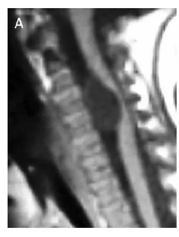 6个月大婴儿“喉炎”后“胳膊无力”，元凶是脊髓内的罕见囊肿，可以全麻手术吗？