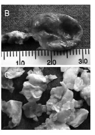 图1，b 囊肿壁的肉眼观。c 囊肿内容物的肉眼观