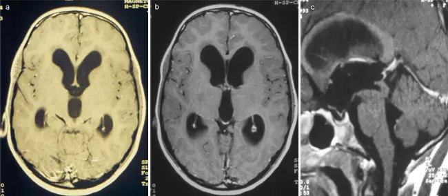 术前磁共振图像显示，因病变压迫导水管，导致三脑室梗阻性脑积水，疑为低级别肿瘤。