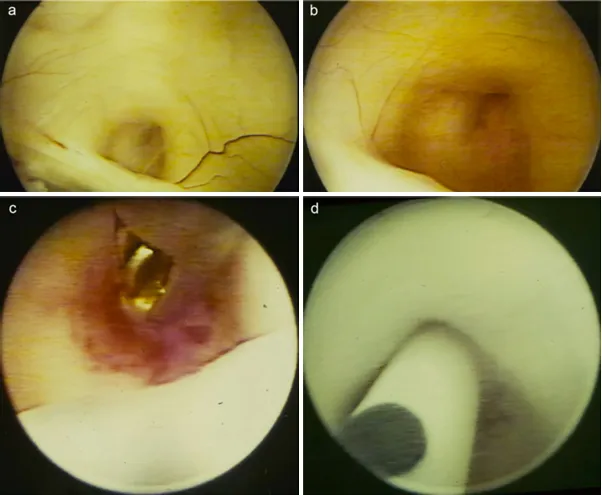 图2：术中内镜视角，位于后连合上方被闭塞的导水管（a、b）。在内镜活检后（c），通过导水管将导水管支架置入第四脑室（d）。