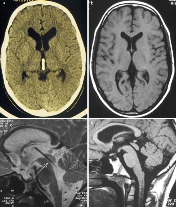 图3:术后CT（a）、磁共振图像（b、c、d）均显示导水管支架的定位情况。此外，侧脑室及第三脑室体积的明显减小，表明支架功能完好。