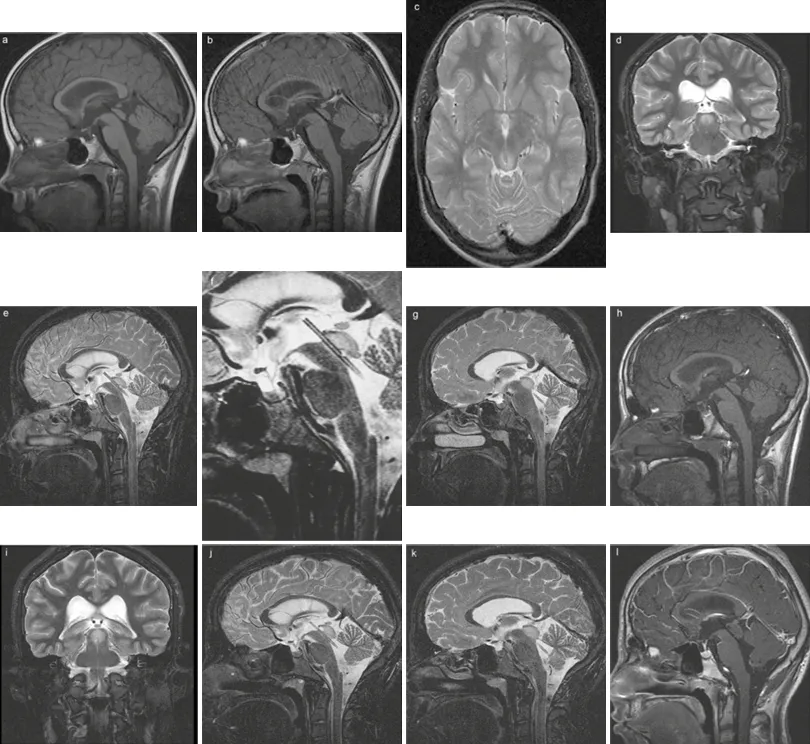 图4：术后随访影像，分别显示在术后2年（a、b）、6年（c、d、e、f、g、h）以及9年（i、j、k、I）时的情况，均表明支架功能和位置完好。