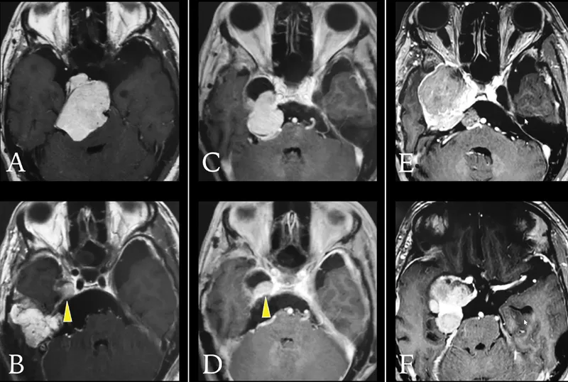 脑膜瘤复发还能治好吗？全面侵袭海绵窦与颈内动脉，第3次手术如何全切？