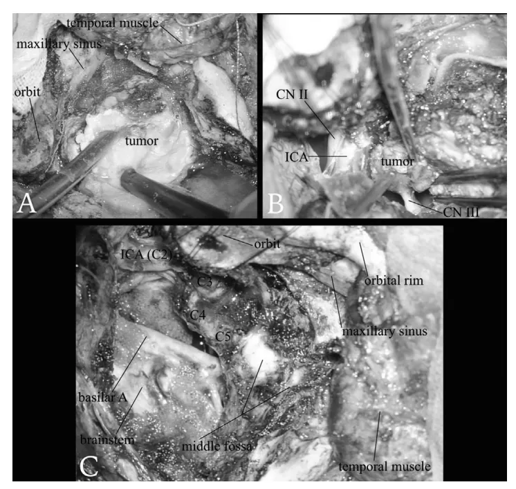 术中：(A)使用超声吸引器 切除肿瘤的右侧中颅窝部分。(B)右侧动眼神经 完全被肿瘤包绕、侵犯。(C)通过经颧骨-经海绵窦入路结合扩大中颅窝入路 实现肿瘤大体全切 后的最终术野。随着肿瘤海绵窦内部分的切除，右侧颈内动脉的海绵窦段 已被剥脱裸露。脑干的侧面得到了良好的显露。
