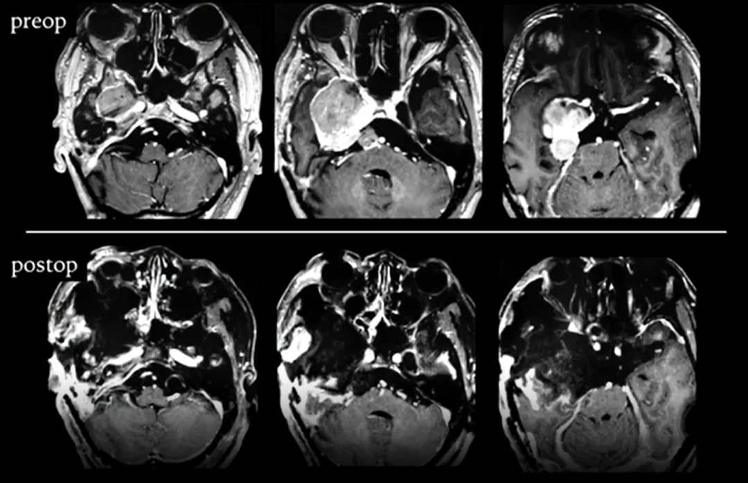 第三次手术，术前术后影像