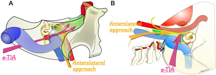 当传统入路遇上岩尖“死角”，“双镜联合”手术如何顺利切除复杂颈静脉孔区