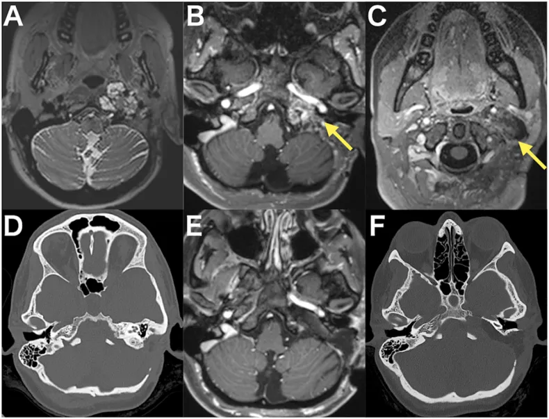 图1，A：术前T2加权MRI显示高信号的颈静脉孔区肿瘤。B和C：术前钆增强T1加权MRI显示肿瘤呈部分强化，从岩尖延伸至颈部区域（箭头所示）。D：术前CT扫描显示岩骨内病理性骨质改变。E：术后钆增强T1加权MRI确认了肿瘤的近全切除。F：术后CT扫描显示手术径路，突出显示已被磨除的岩尖。