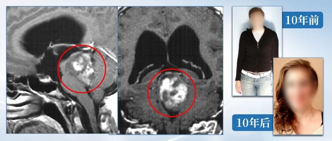 中脑胶质瘤术后19年无复发