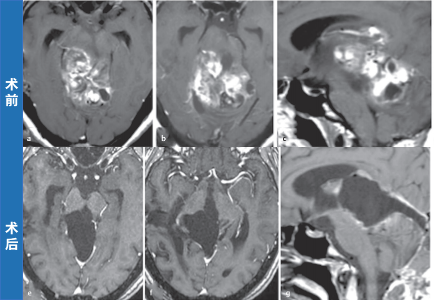 中脑胶质瘤术后10年未复发