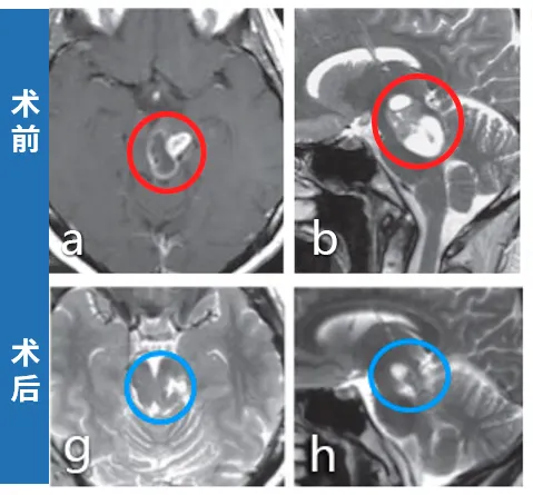 中脑胶质瘤术后9年无复发