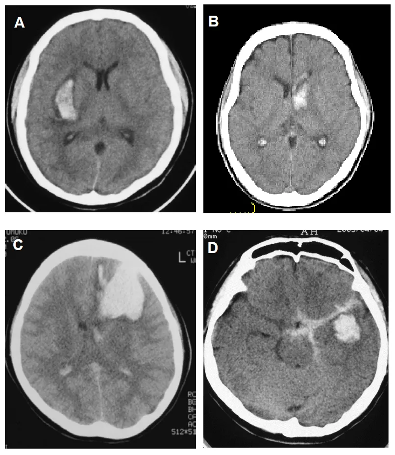 A:壳核出血 B:尾状核头出血 C:额叶出血 D:颞叶前半部分出血