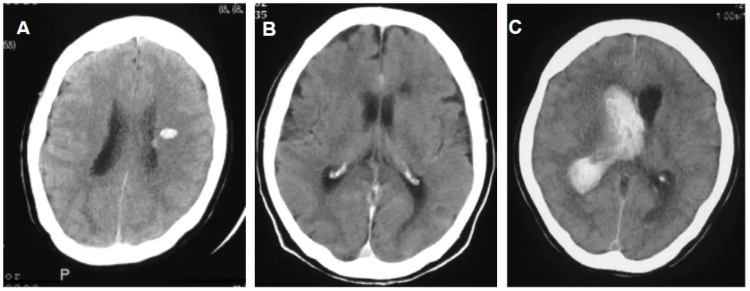 A：侧脑室前部室管膜下区出血  B：脑池前半段蛛网膜下腔出血  C：起源不明、弥漫分布的原发性脑室内出血