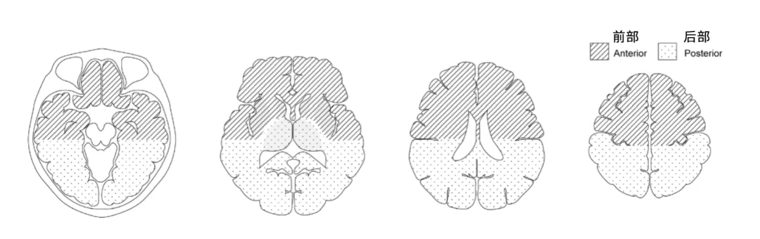 分好组之后，一部分做直接搭桥（颞浅动脉 - 大脑中动脉吻合），一部分只用药，并随访5年。