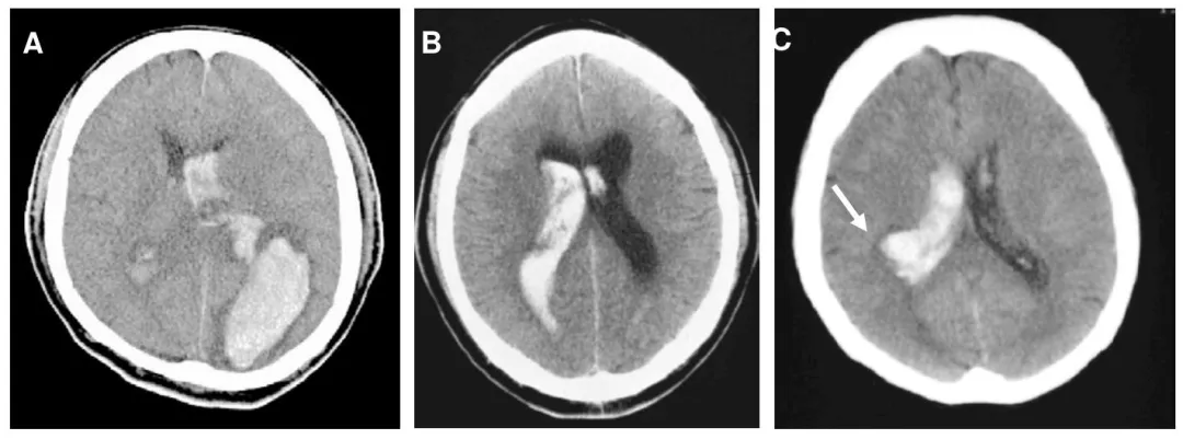 后部出血代表性CT图像，含顶叶/枕叶/丘脑/脑室后部等区域出血示例