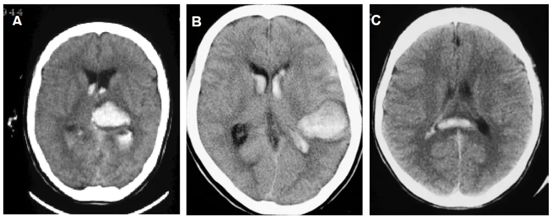 A:丘脑出血 | B:颞叶后半部出血 | C:胼胝体后半部出血