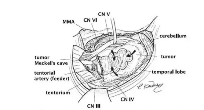 右侧kawase入路的手术示意图。肿瘤供血血管(幕动脉)被切断，三叉神经从肿瘤处被牵拉出来。肿瘤被减压并朝肿瘤附着处方向被牵拉