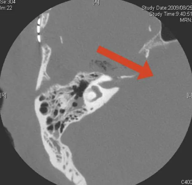 图1. 一名右侧大型岩斜区脑膜瘤患者切除术后轴位CT扫描。红色箭头显示了前岩骨切除术后从中颅窝通往后颅窝的手术通道。