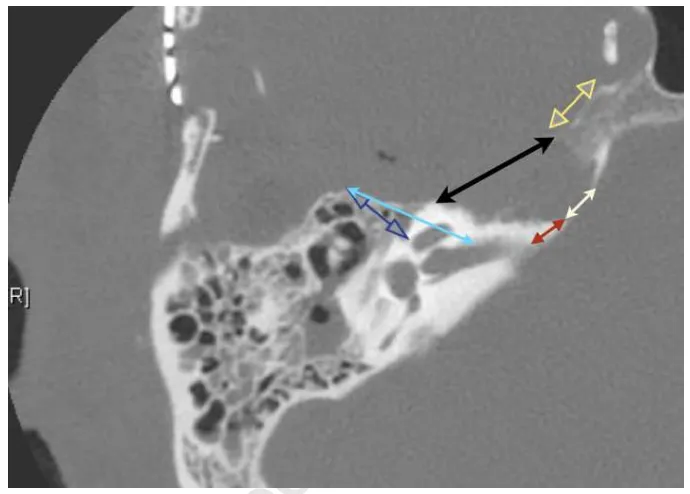 图2. 本研究中在术后轴位视图中测量的不同距离已用不同颜色显示：浅蓝色：钻磨起始边缘与内听道之间的轴位距离（N1）；红色：钻磨结束边缘与内听道之间的轴位距离（N2）；深蓝色：钻磨起始边缘与最近半规管之间的轴位距离（N3）；黄色：轴位最近钻磨边缘到岩尖的距离（N4）；黑色：轴位钻磨入口长度（N5）；白色：轴位钻磨出口长度（N6）
